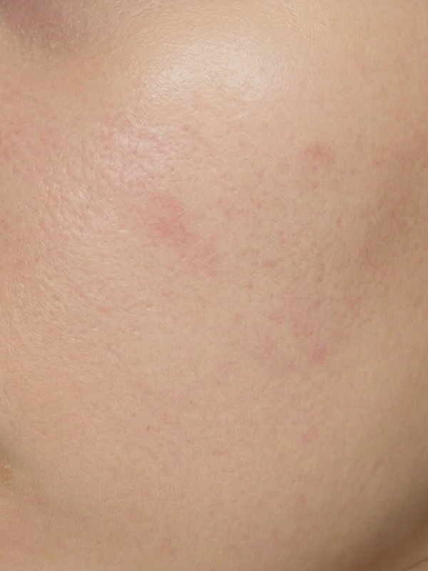 Korean skincare results - after using K-beauty routine
