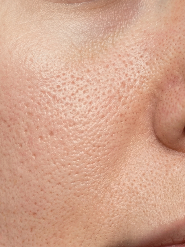 Korean skincare results - before using K-beauty routine