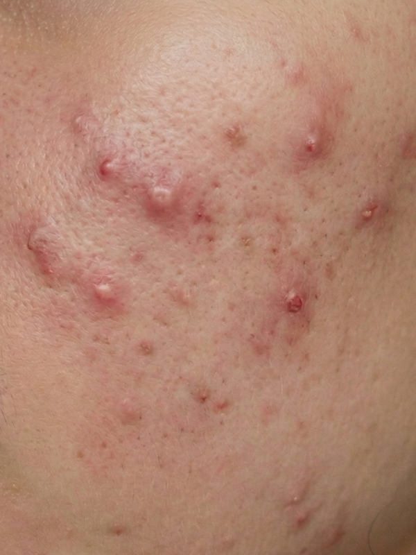 Korean skincare results - before using K-beauty routine